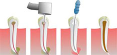 endodontics