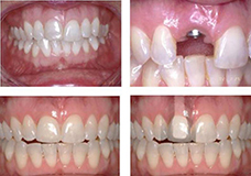 implant